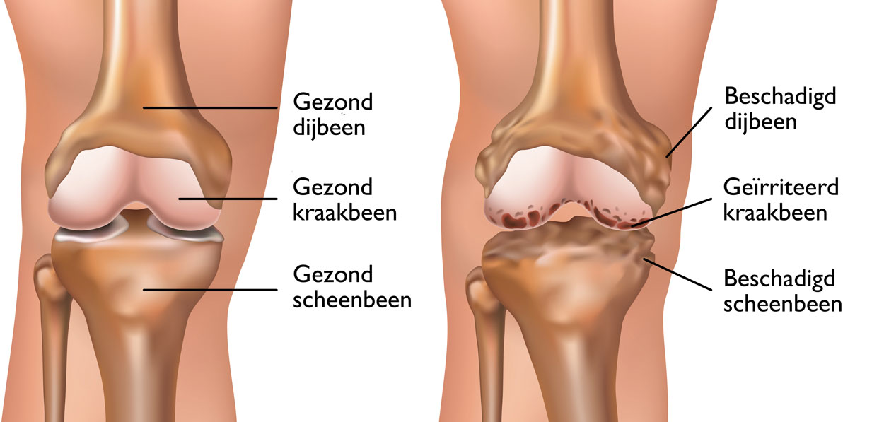 Fysio Ter Horst Artrose knie heup